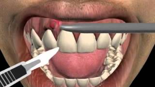 How to treat a tooth abscess [upl. by Llerehs]