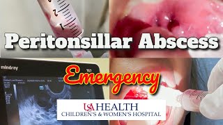 Peritonsillar Abscess Emergency and Needle Aspiration [upl. by Roberto289]