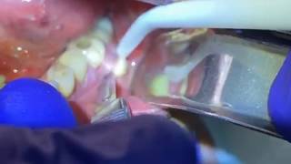 Draining a Dental Abscess  Advanced Dental Care [upl. by Teri]