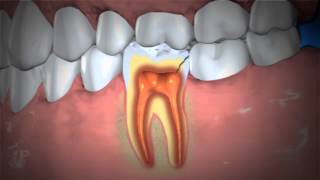 Treatment of Abscessed Teeth [upl. by Letnahs]