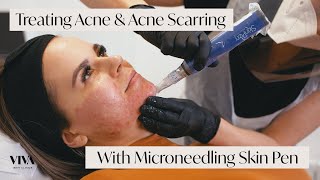 This Is Microneedling for Acne Scarring 🎯 [upl. by Ivana]