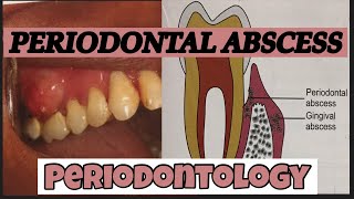 PERIODONTAL ABSCESS II PERIODONTOLOGY [upl. by Giuseppe]