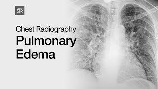 Chest Radiography Pulmonary Edema [upl. by Oeniri]