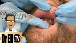 gum abscess drainage  Full VIDEO [upl. by Lawtun]