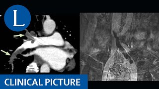 Thrombotic Thrombocytopenic Purpura TTP and Hemolytic Uremic Syndrome HUS [upl. by Ylerebmik]