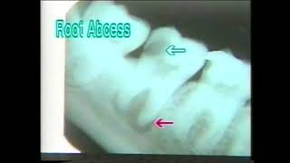 1241 Root Abscess  Dental Xrays  Dr Vaidya [upl. by Chuck]