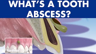 TOOTH ABSCESS dental infection  PHLEGMON symptoms and treatment © [upl. by Anatola]