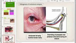 Entropion [upl. by Lotz]