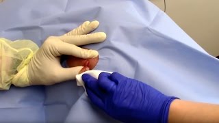 Abscess Drainage Performed by Dermatologist Dr David Myers [upl. by Moir]