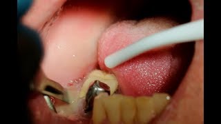 Explosive Drainage of Pus from a Dental Abscess [upl. by Milan]