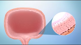 Treatment for Bladder Cancer [upl. by Leong26]