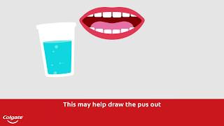 How To Treat a Gum or Tooth Abscess  Colgate® [upl. by Tollmann]