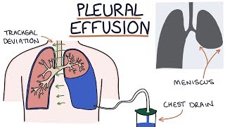 Understanding Pleural Effusions [upl. by Florrie]