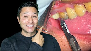 Dental Abscess  Intraoral Incision and Drainage Dental abscess [upl. by Nyleahcim756]