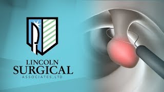 Colon Polyp Removal  Colonoscopy [upl. by Orazio]