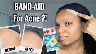 BANDAID FOR ACNE  I Tested Hydrocolloid Bandages for 1 Week  Hydro Seal BandAid for Acne [upl. by Accebar]