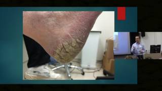 Itch in Elderly Skin  Dr Ian Bekker [upl. by Notsnarc865]