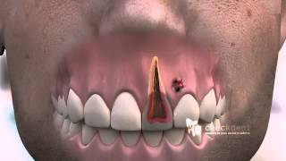 How to treat a dental Fistula [upl. by Tally419]