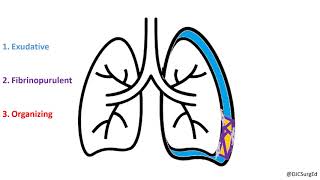 Empyema and Pleural Effusions [upl. by Aenel]