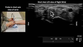 Median Nerve Anatomy and USGuided Injection [upl. by Giule]