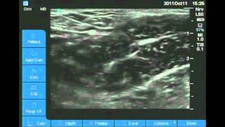 Ultrasound Guided obturator nerve block [upl. by Llenehc]