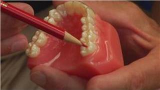 Tooth amp Gum Abscesses  How Dentists Drain an Abscessed Tooth [upl. by Ennaitsirhc]