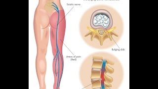 What is Sciatica [upl. by Namlaz]