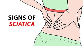 Signs of Sciatica [upl. by Netnerb339]