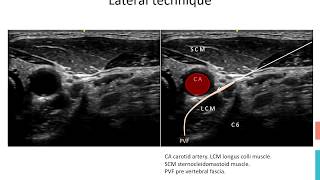 Stellate Ganglion Block [upl. by Aynotan]