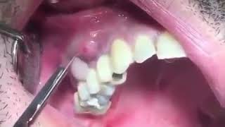 dental abscess drainage [upl. by Columbyne]