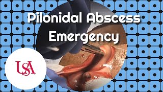 Pilonidal Abscess Emergency Incision amp Drainage [upl. by Junji]