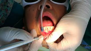 Periapical Abscess Drainage with dental laser [upl. by Leid769]