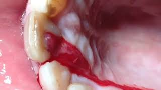 Drainage abscess through root canal [upl. by Ongineb]