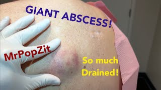 Abscess Drainage RealLife Cases [upl. by Cristabel]